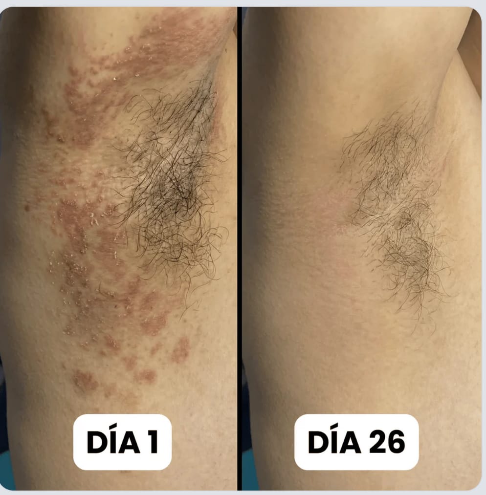 Bifonazol Forte 3 EN 1 | Crema Intensiva Contra Hongos y Tiña