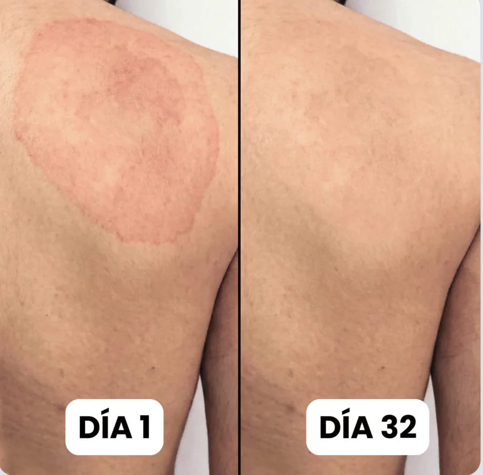 Bifonazol Forte 3 EN 1 | Crema Intensiva Contra Hongos y Tiña