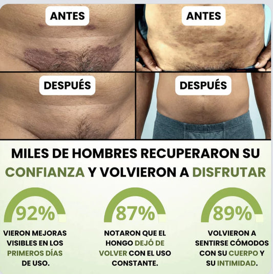 Bifonazol Forte 3 EN 1 | Crema Intensiva Contra Hongos y Tiña